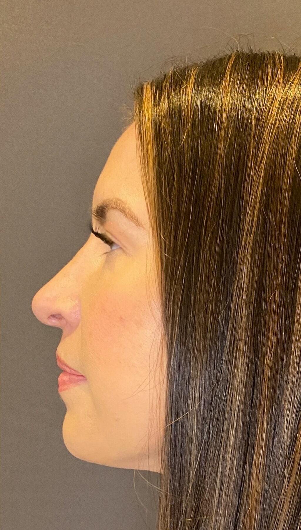 Rhinoplasty Before & After Gallery - Patient 151510790 - Image 8