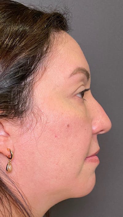 Non-Surgical Rhinoplasty Before & After Gallery - Patient 151452164 - Image 1