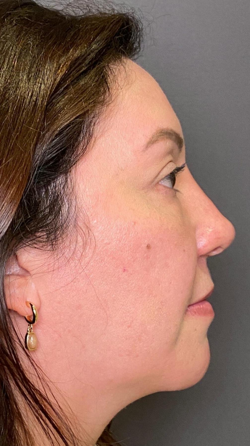 Non-Surgical Rhinoplasty Before & After Gallery - Patient 151452164 - Image 2