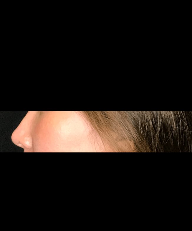 Non-Surgical Rhinoplasty Before & After Gallery - Patient 151452166 - Image 1