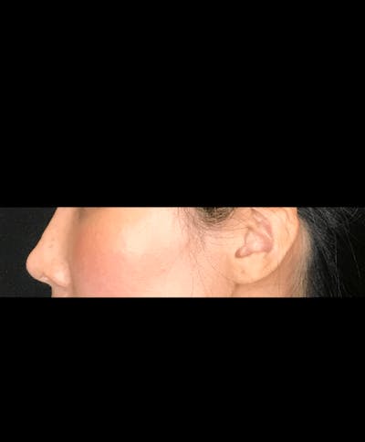 Non-Surgical Rhinoplasty Before & After Gallery - Patient 151452166 - Image 2