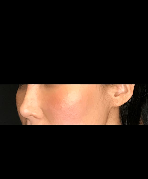 Non-Surgical Rhinoplasty Before & After Gallery - Patient 151452166 - Image 4