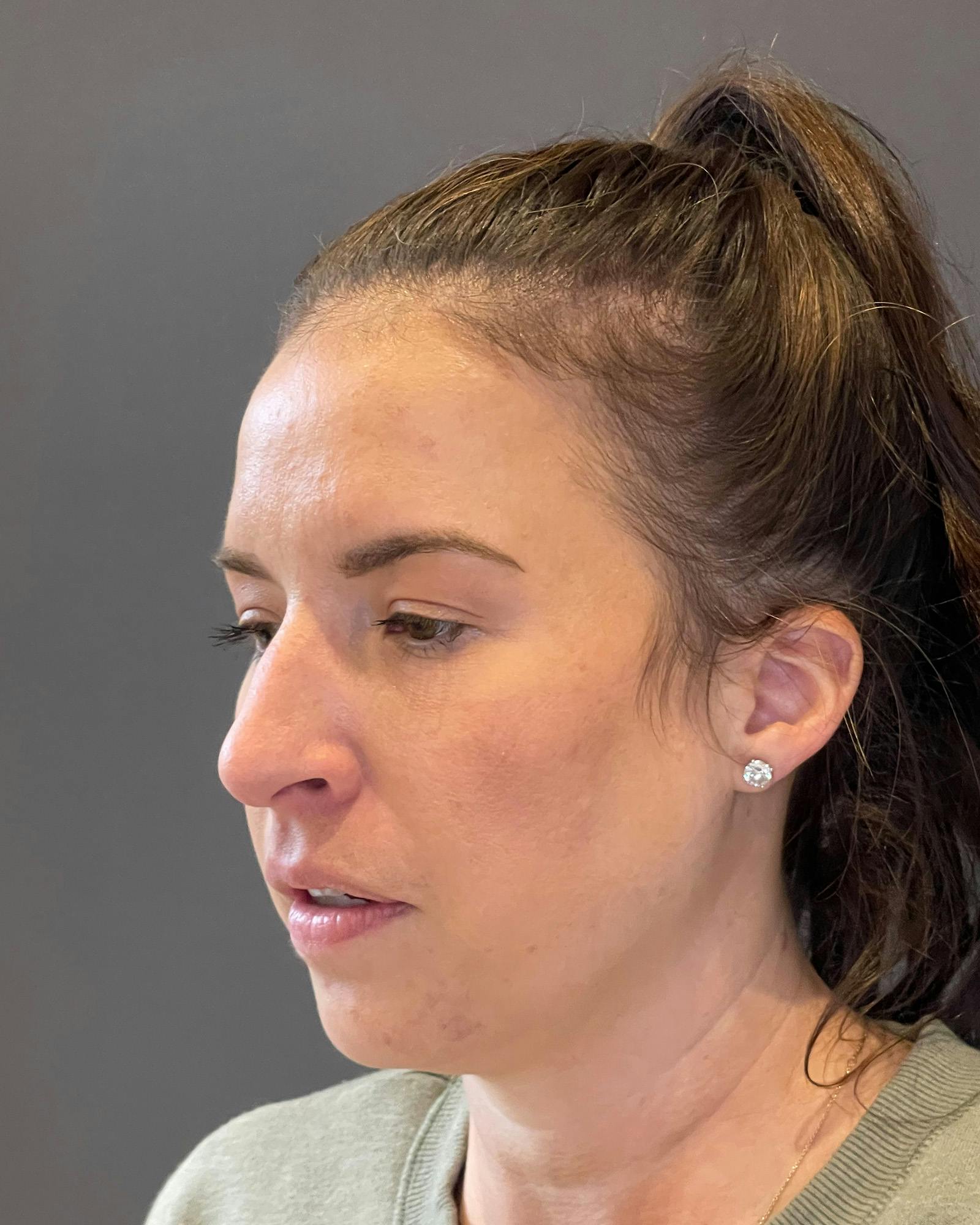 Rhinoplasty Before & After Gallery - Patient 151510790 - Image 15