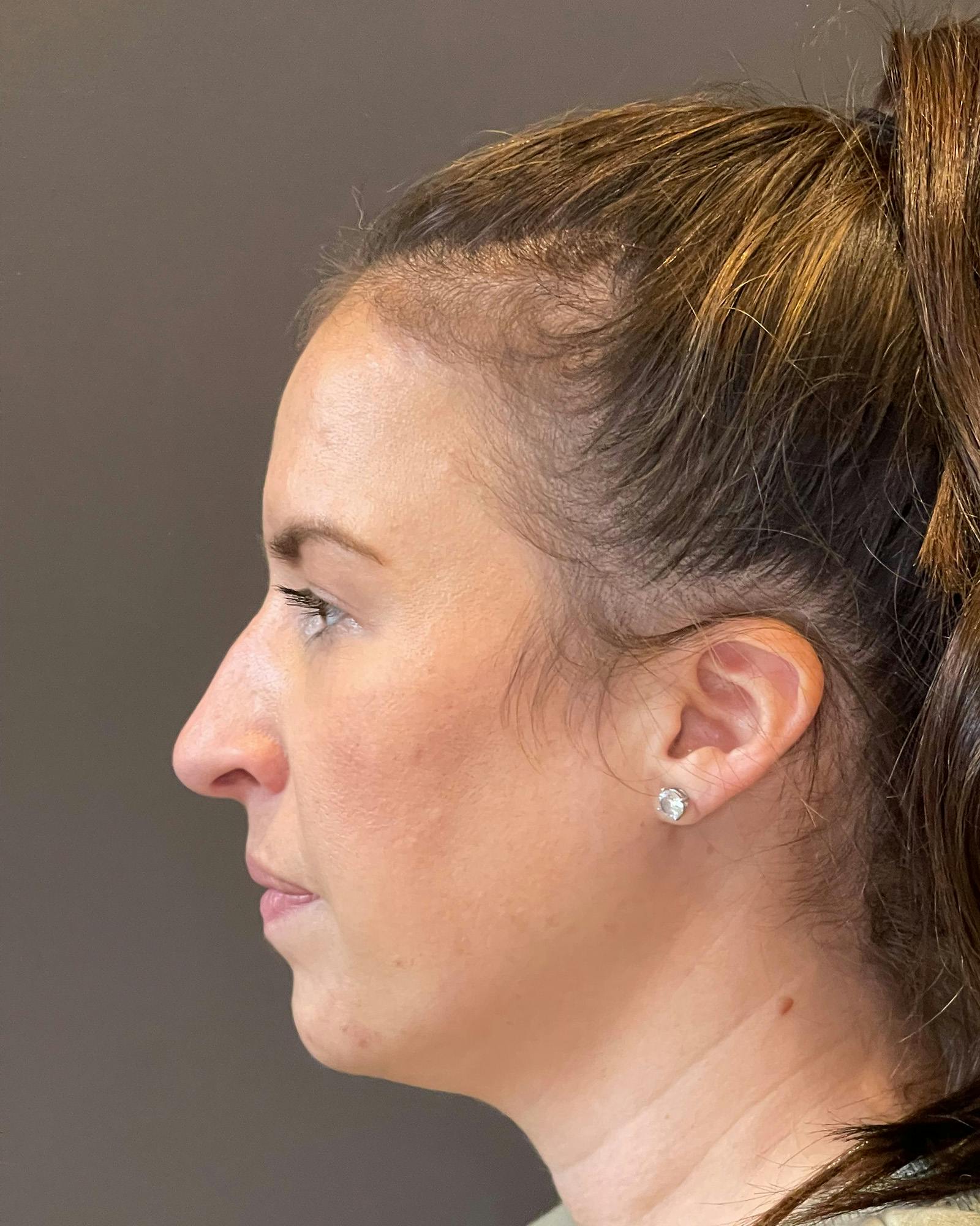 Rhinoplasty Before & After Gallery - Patient 151510790 - Image 17