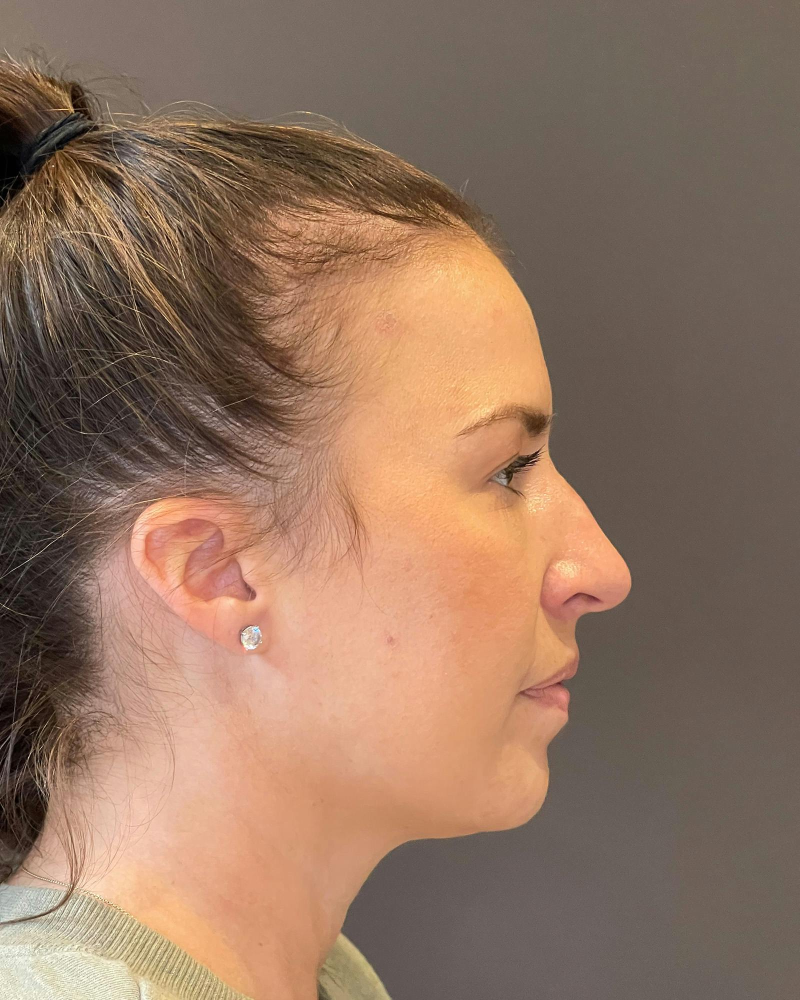 Rhinoplasty Before & After Gallery - Patient 151510790 - Image 9
