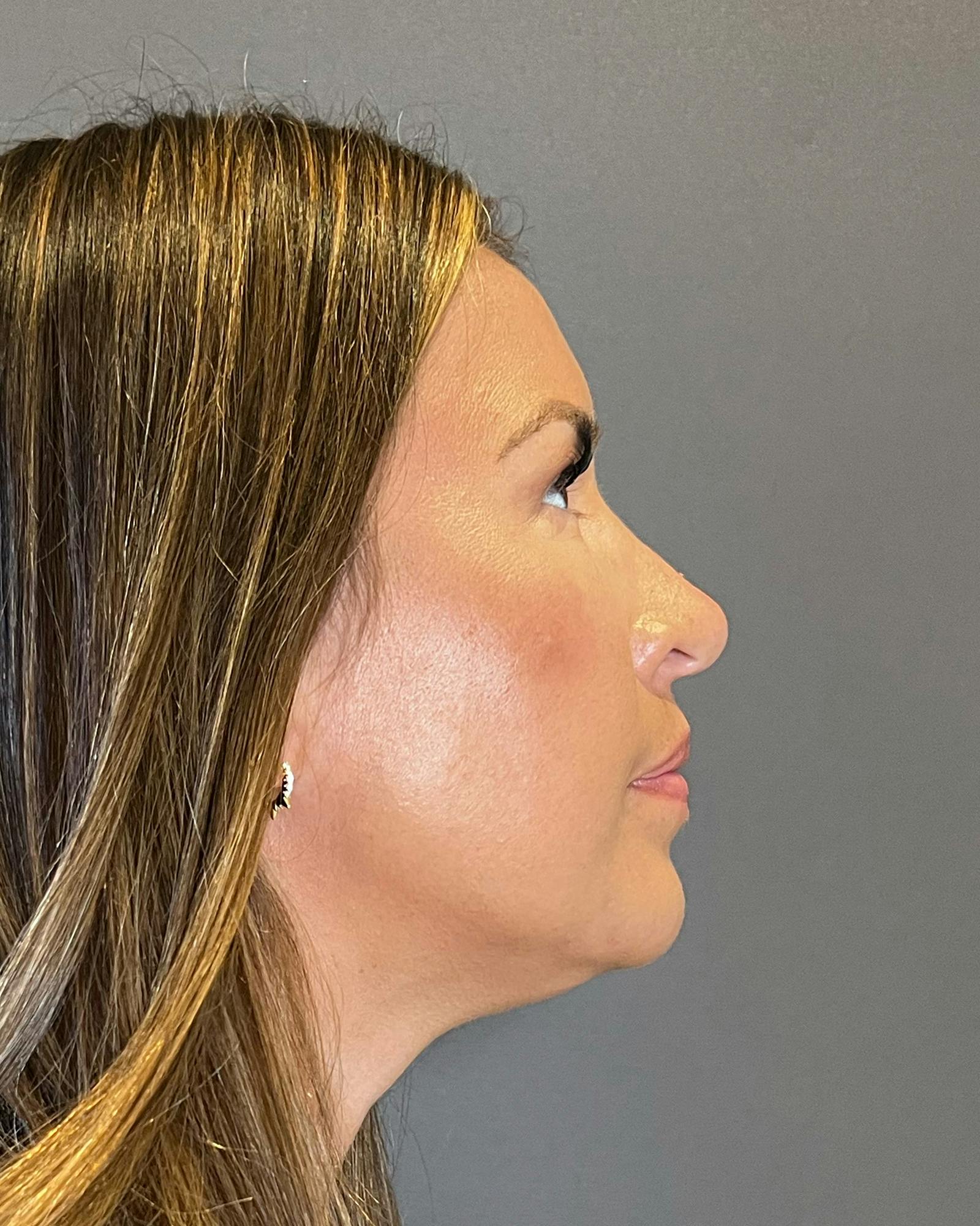 Rhinoplasty Before & After Gallery - Patient 151510790 - Image 10
