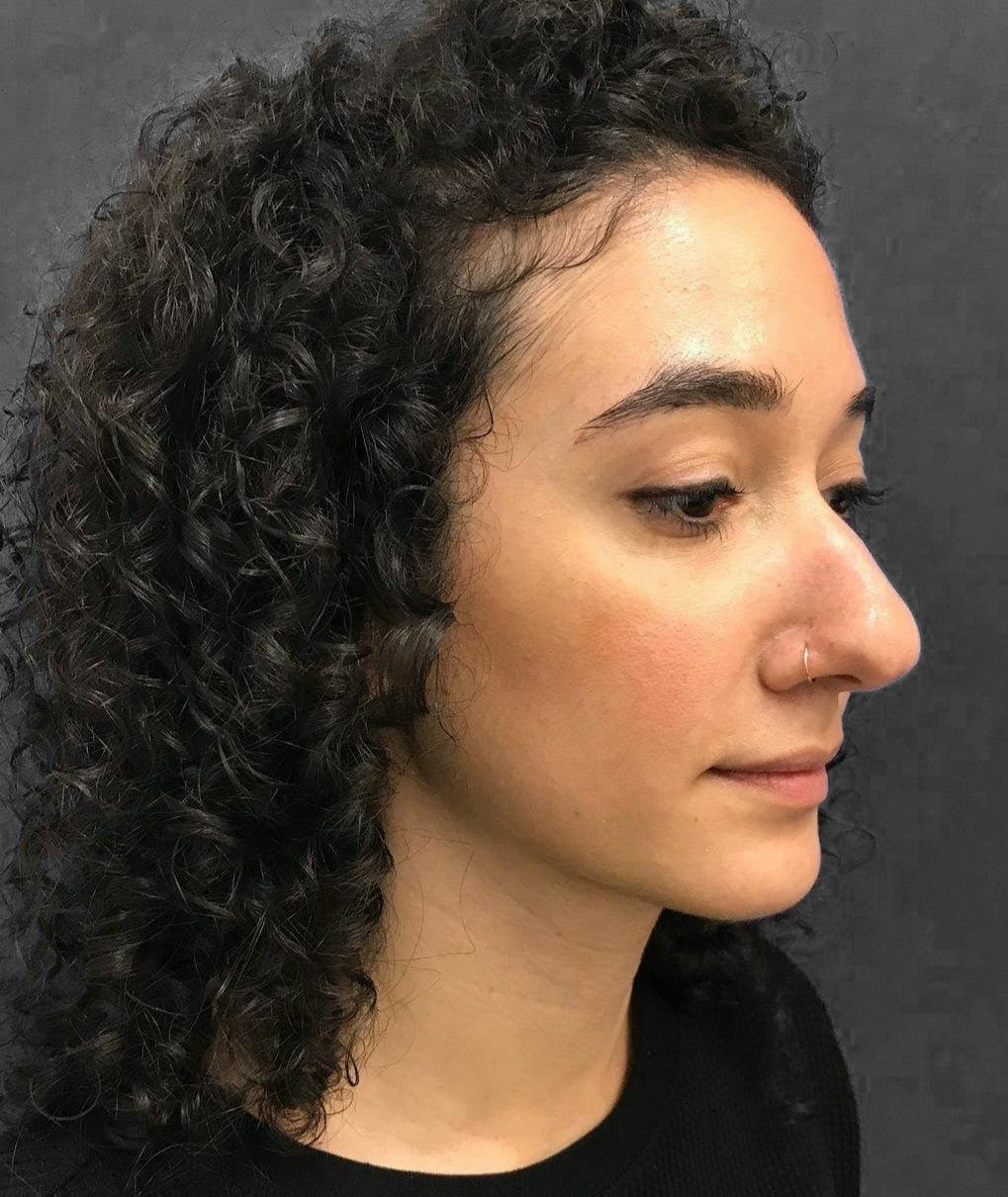Rhinoplasty Before & After Gallery - Patient 151510786 - Image 3