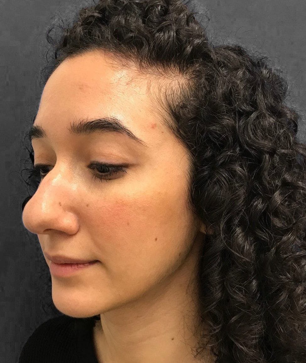 Rhinoplasty Before & After Gallery - Patient 151510786 - Image 7