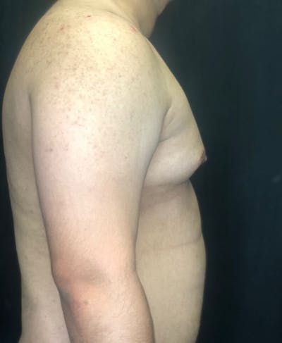 Gynecomastia Before & After Gallery - Patient 151452128 - Image 1