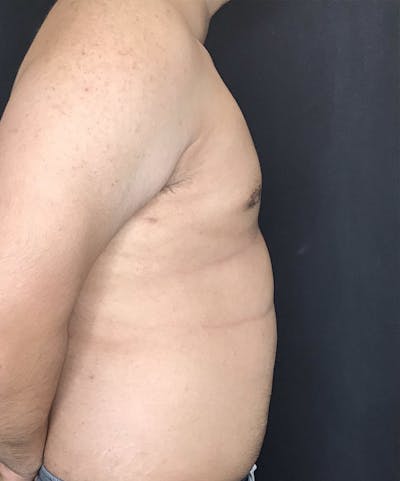 Gynecomastia Before & After Gallery - Patient 151452128 - Image 2