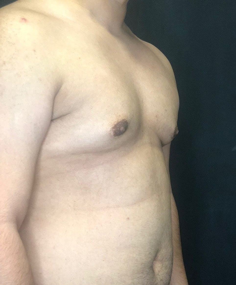 Gynecomastia Before & After Gallery - Patient 151452128 - Image 3