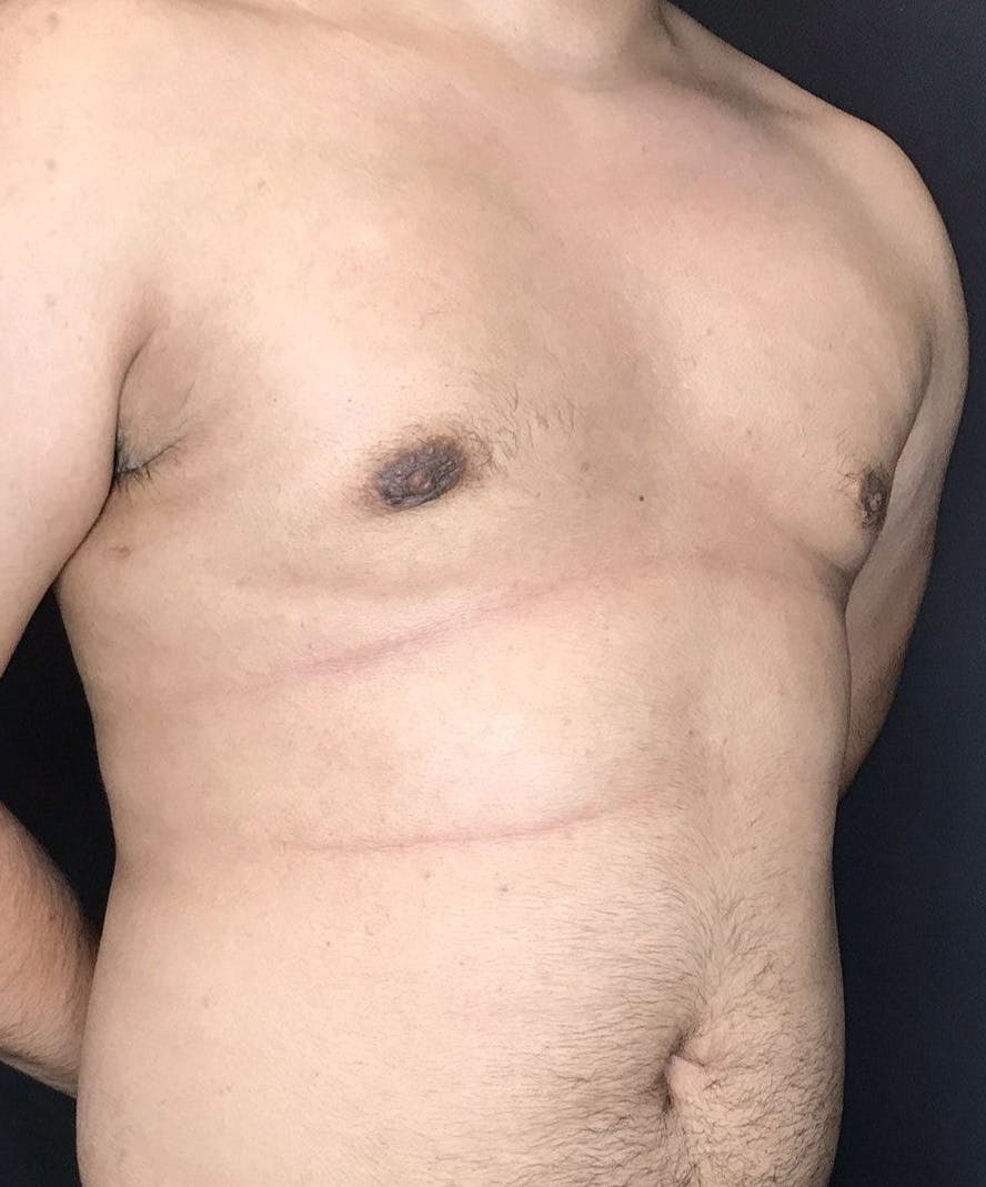 Gynecomastia Before & After Gallery - Patient 151452128 - Image 4