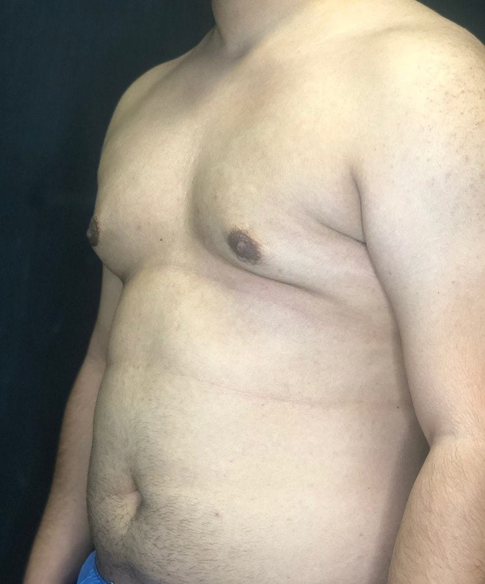 Gynecomastia Before & After Gallery - Patient 151452128 - Image 5