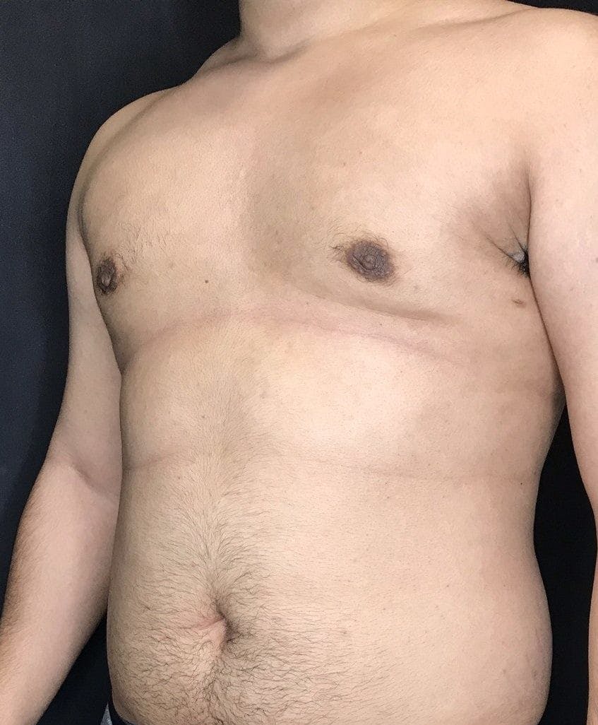 Gynecomastia Before & After Gallery - Patient 151452128 - Image 6