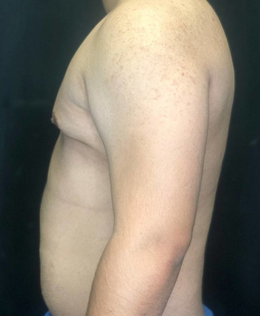Gynecomastia Before & After Gallery - Patient 151452128 - Image 7