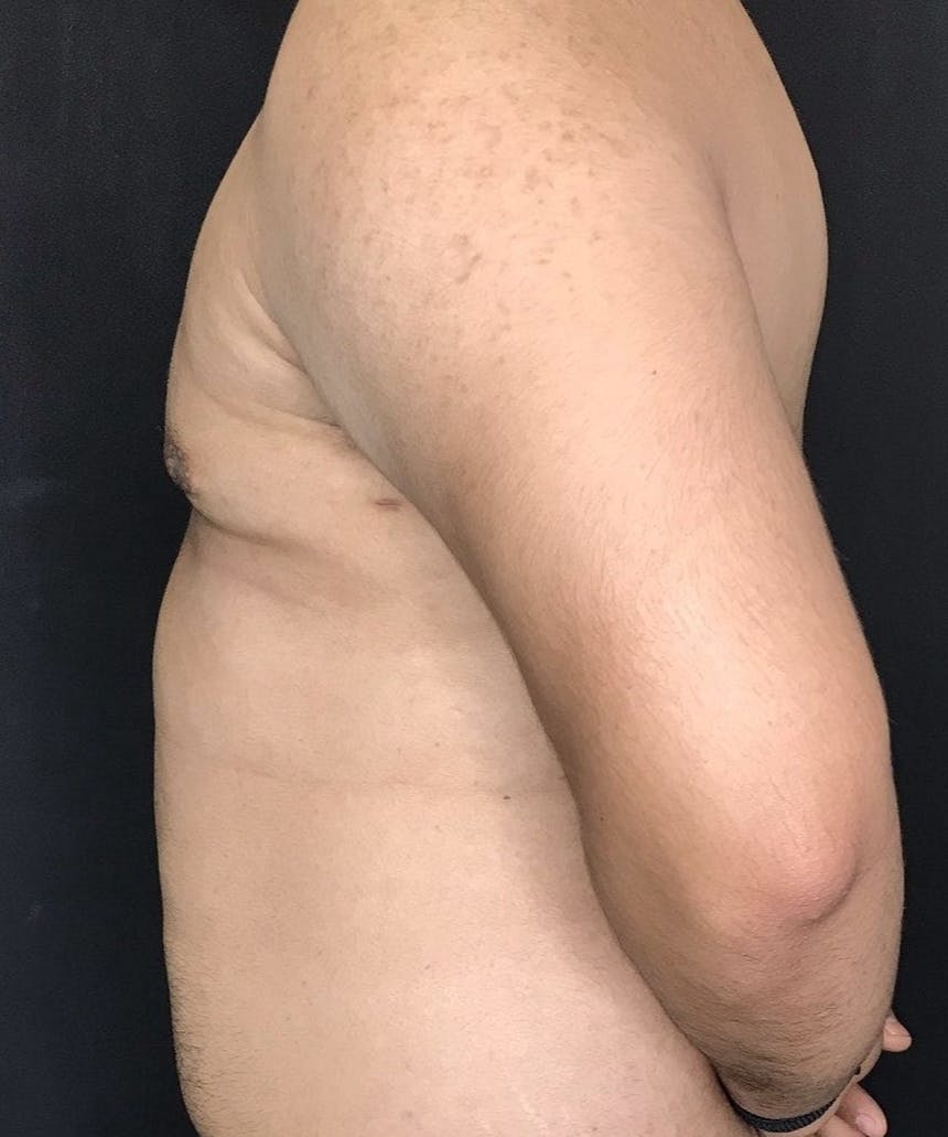 Gynecomastia Before & After Gallery - Patient 151452128 - Image 8