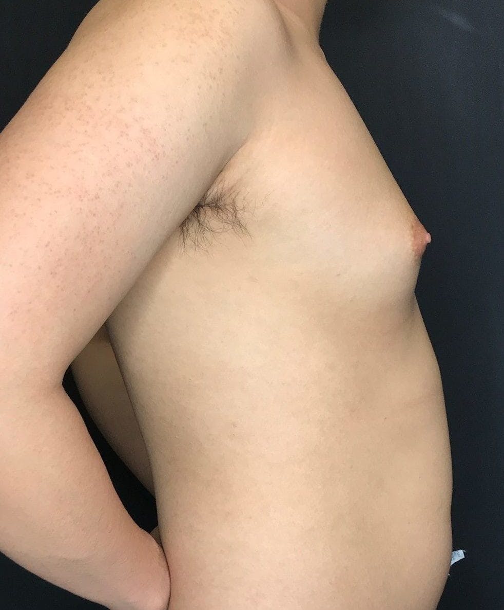 Gynecomastia Before & After Gallery - Patient 151452129 - Image 1