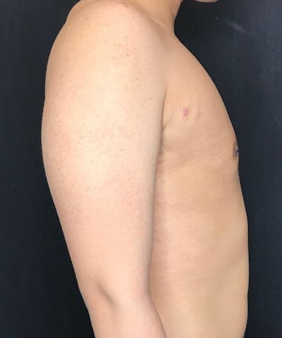 Gynecomastia Before & After Gallery - Patient 151452129 - Image 2