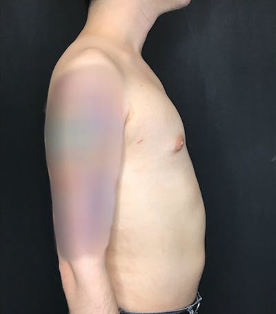 Gynecomastia Before & After Gallery - Patient 151452130 - Image 2