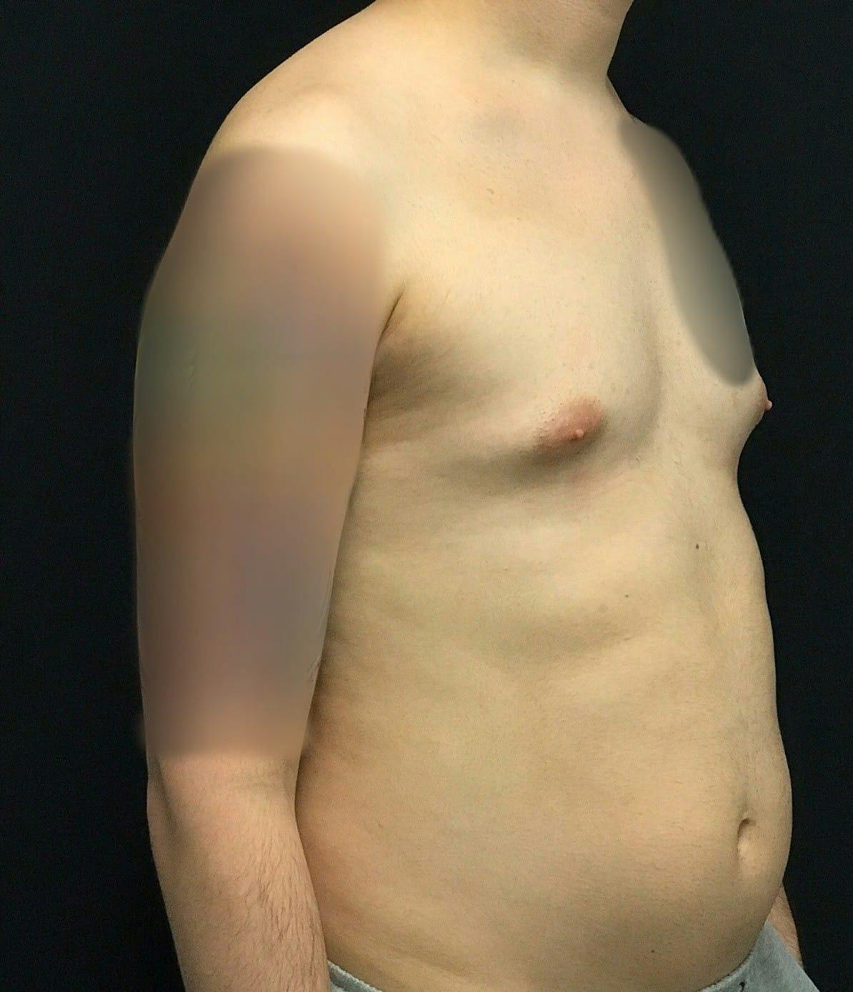 Gynecomastia Before & After Gallery - Patient 151452130 - Image 3