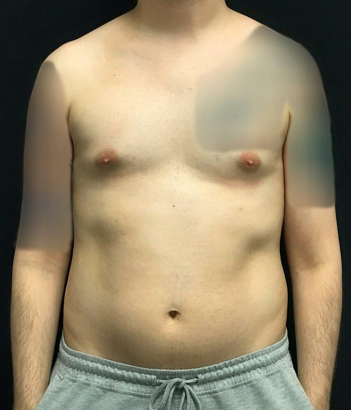 Gynecomastia Before & After Gallery - Patient 151452130 - Image 5