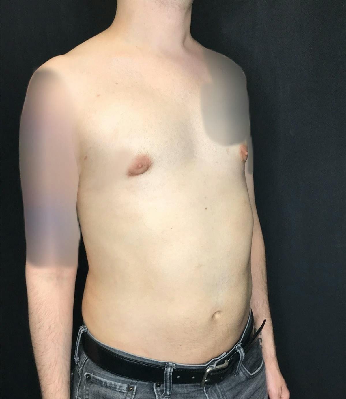 Gynecomastia Before & After Gallery - Patient 151452130 - Image 4