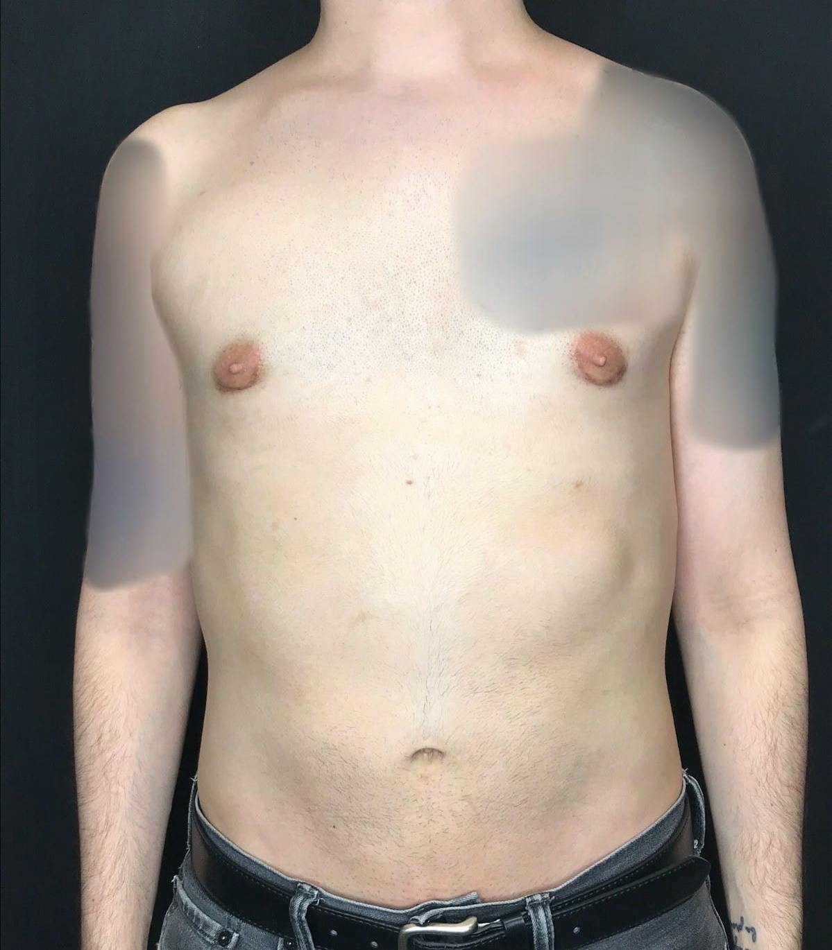 Gynecomastia Before & After Gallery - Patient 151452130 - Image 6