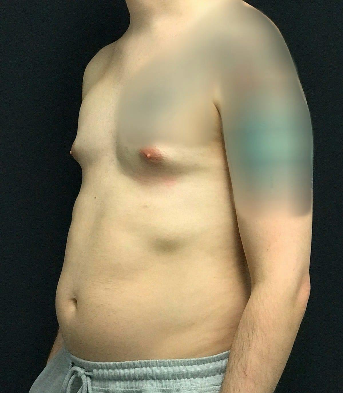 Gynecomastia Before & After Gallery - Patient 151452130 - Image 7
