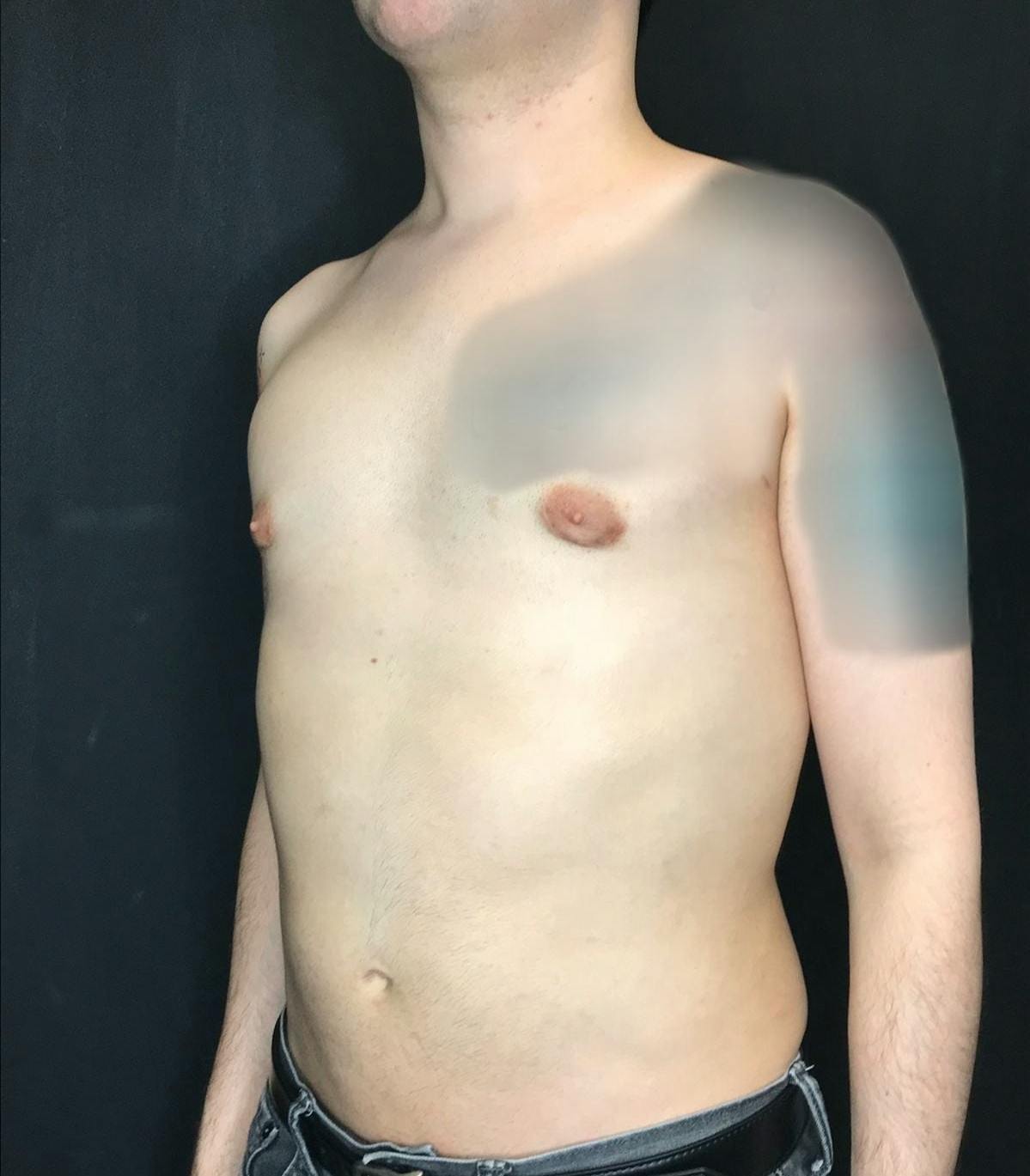 Gynecomastia Before & After Gallery - Patient 151452130 - Image 8