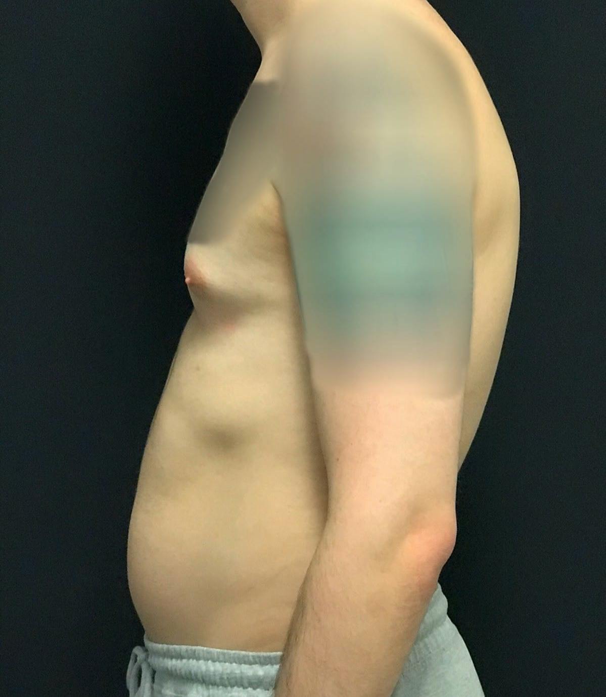 Gynecomastia Before & After Gallery - Patient 151452130 - Image 9