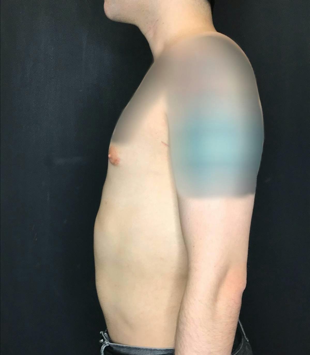 Gynecomastia Before & After Gallery - Patient 151452130 - Image 10