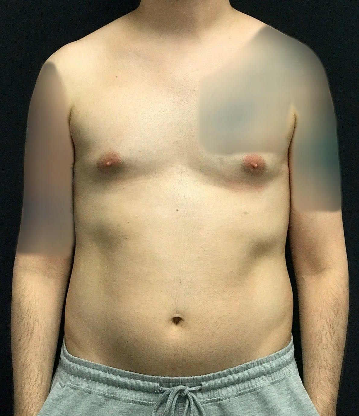 Liposuction Before & After Gallery - Patient 151452151 - Image 1