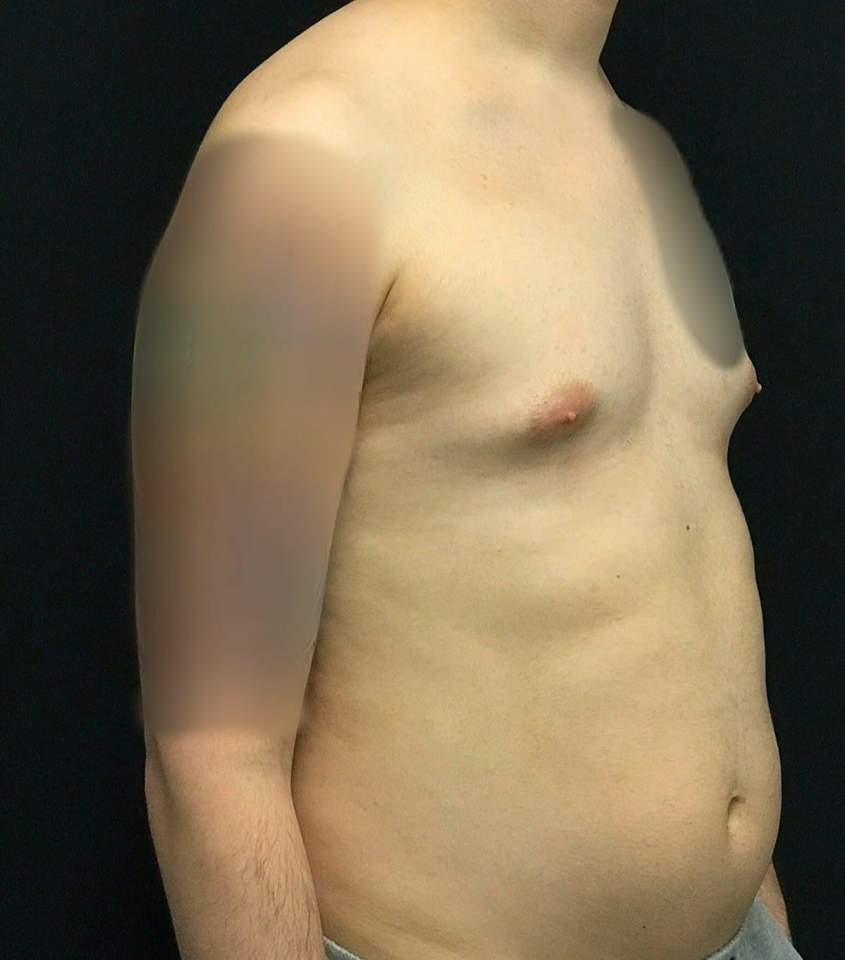 Liposuction Before & After Gallery - Patient 151452151 - Image 3