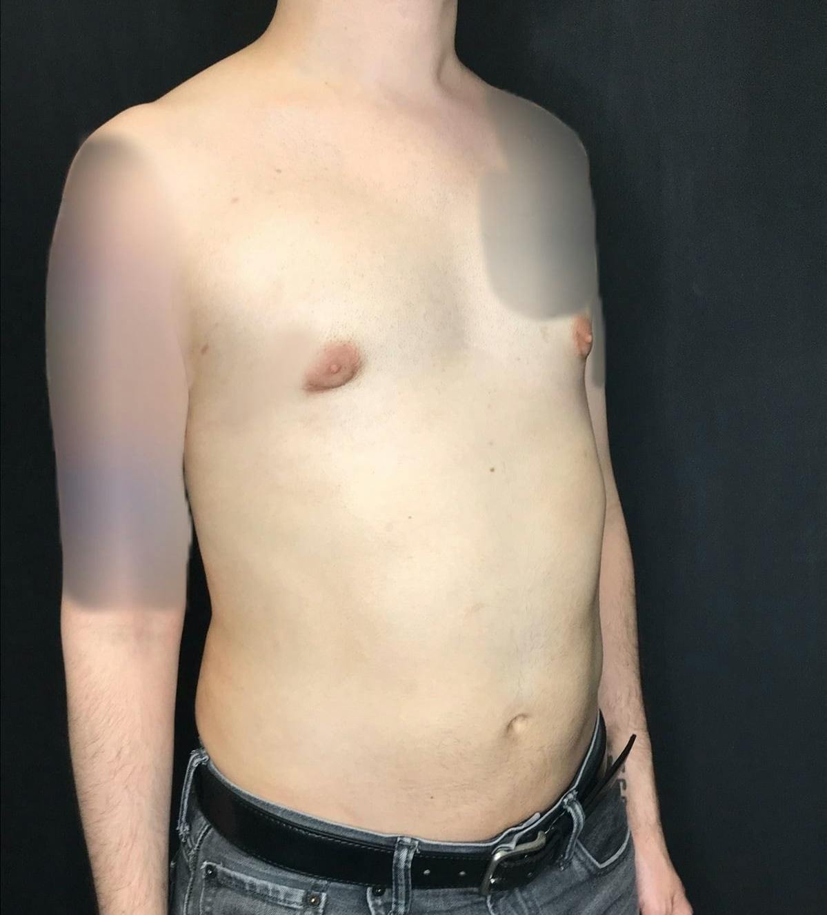 Liposuction Before & After Gallery - Patient 151452151 - Image 4