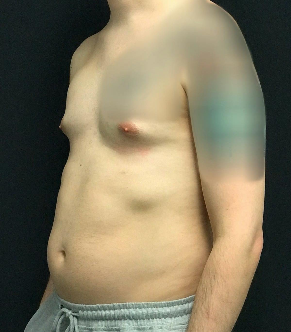 Liposuction Before & After Gallery - Patient 151452151 - Image 7