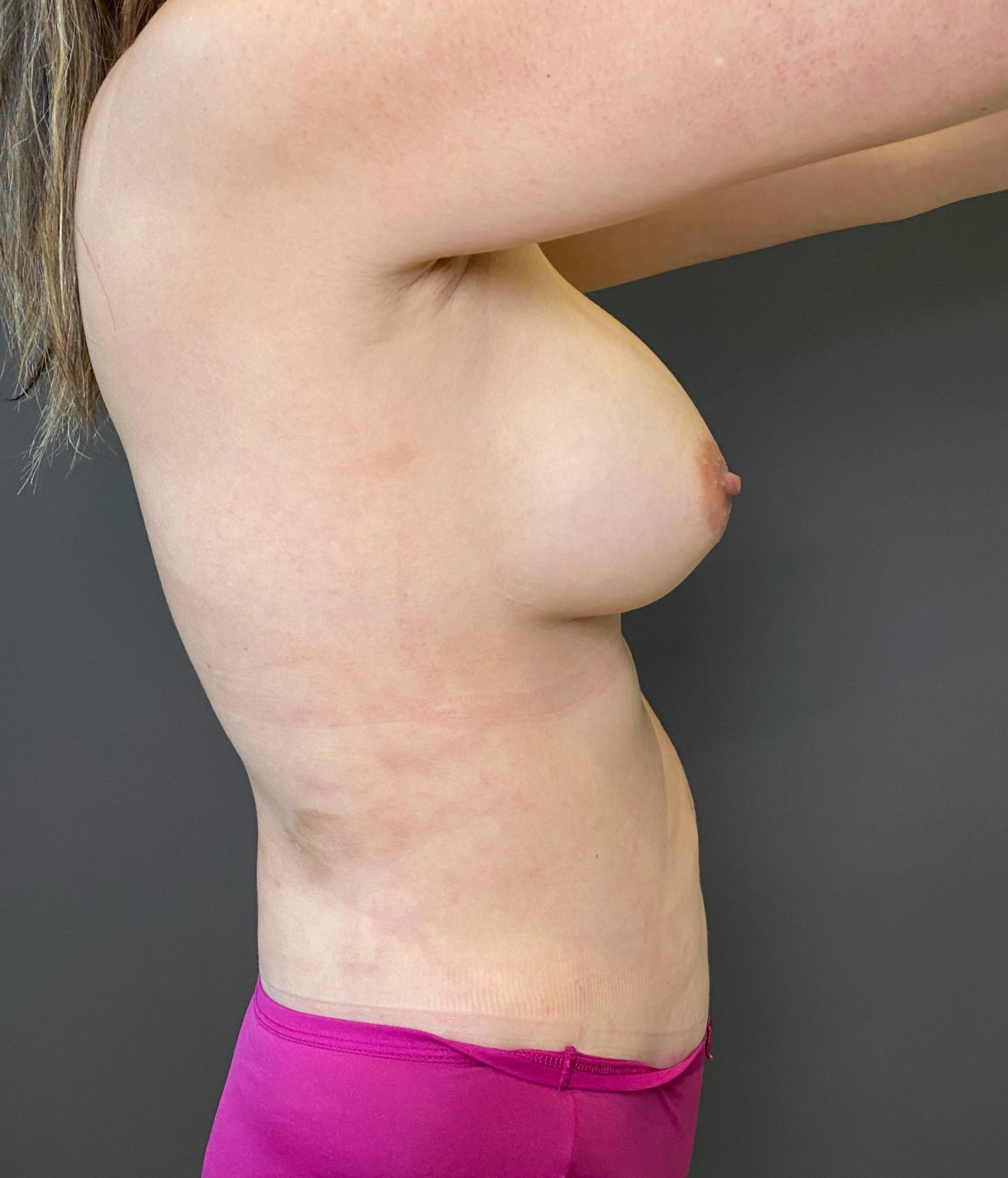 Breast Augmentation Before & After Gallery - Patient 151362512 - Image 10