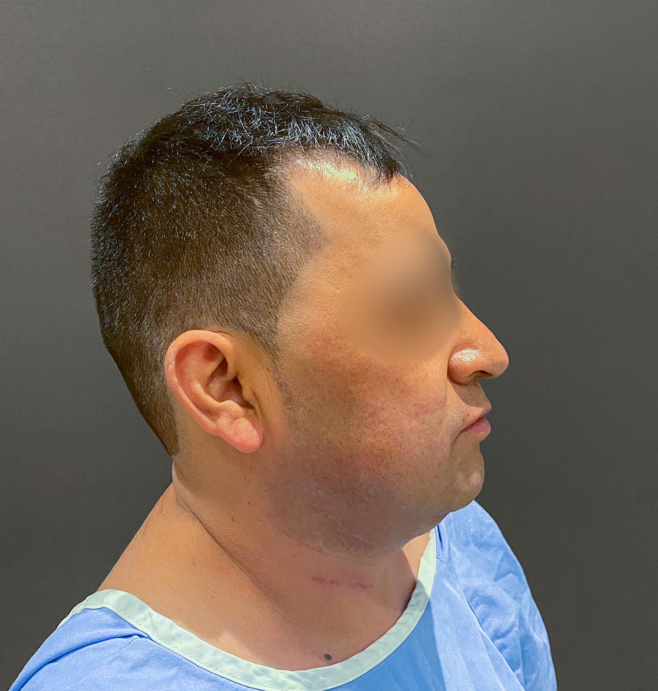 Revision Rhinoplasty Before & After Gallery - Patient 173906475 - Image 1