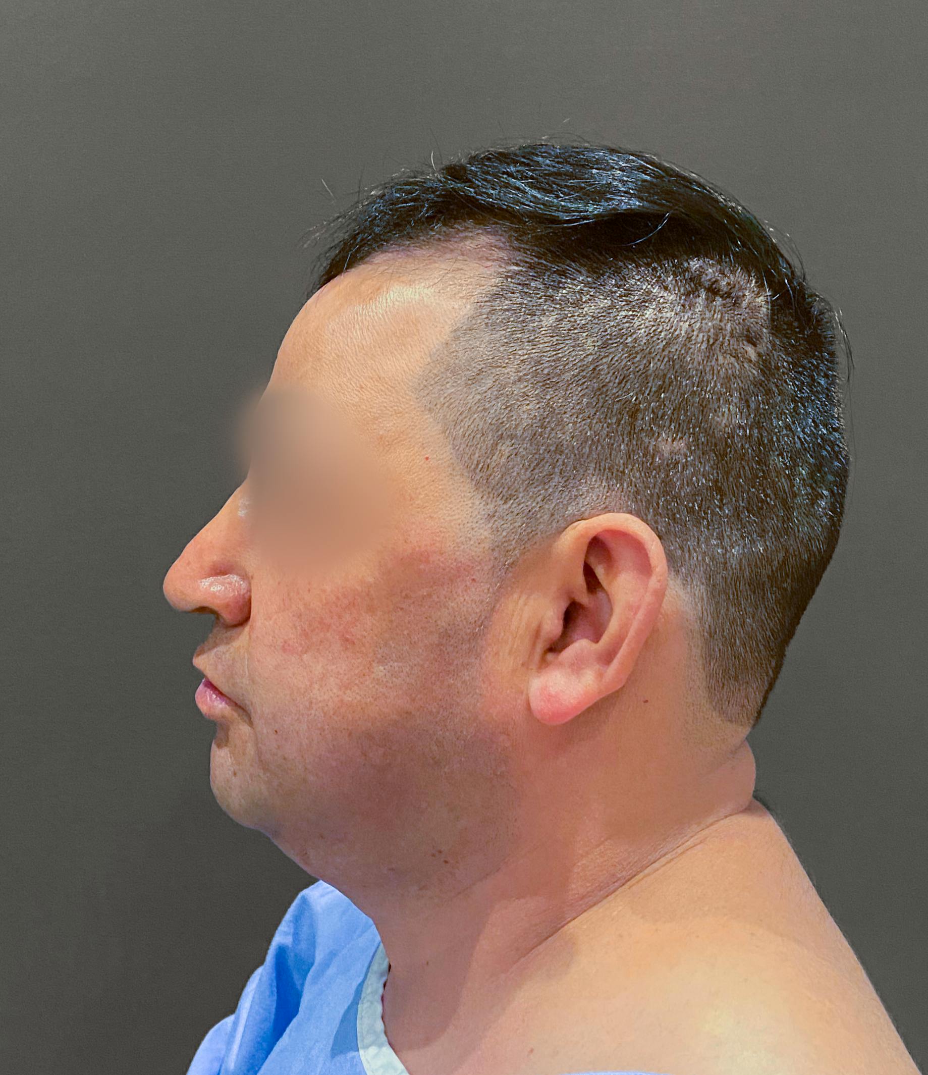 Revision Rhinoplasty Before & After Gallery - Patient 173906475 - Image 5