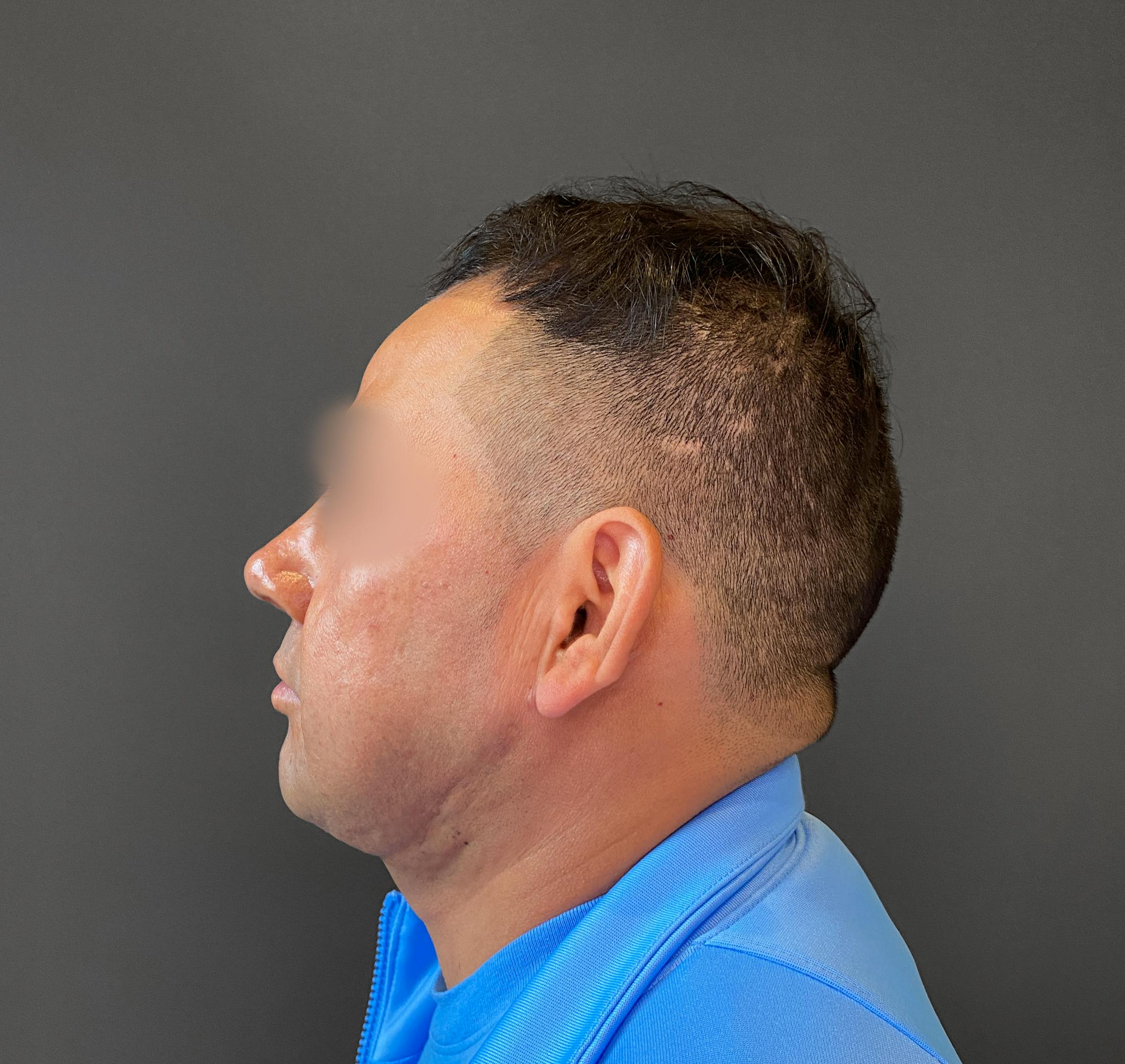 Revision Rhinoplasty Before & After Gallery - Patient 173906475 - Image 6