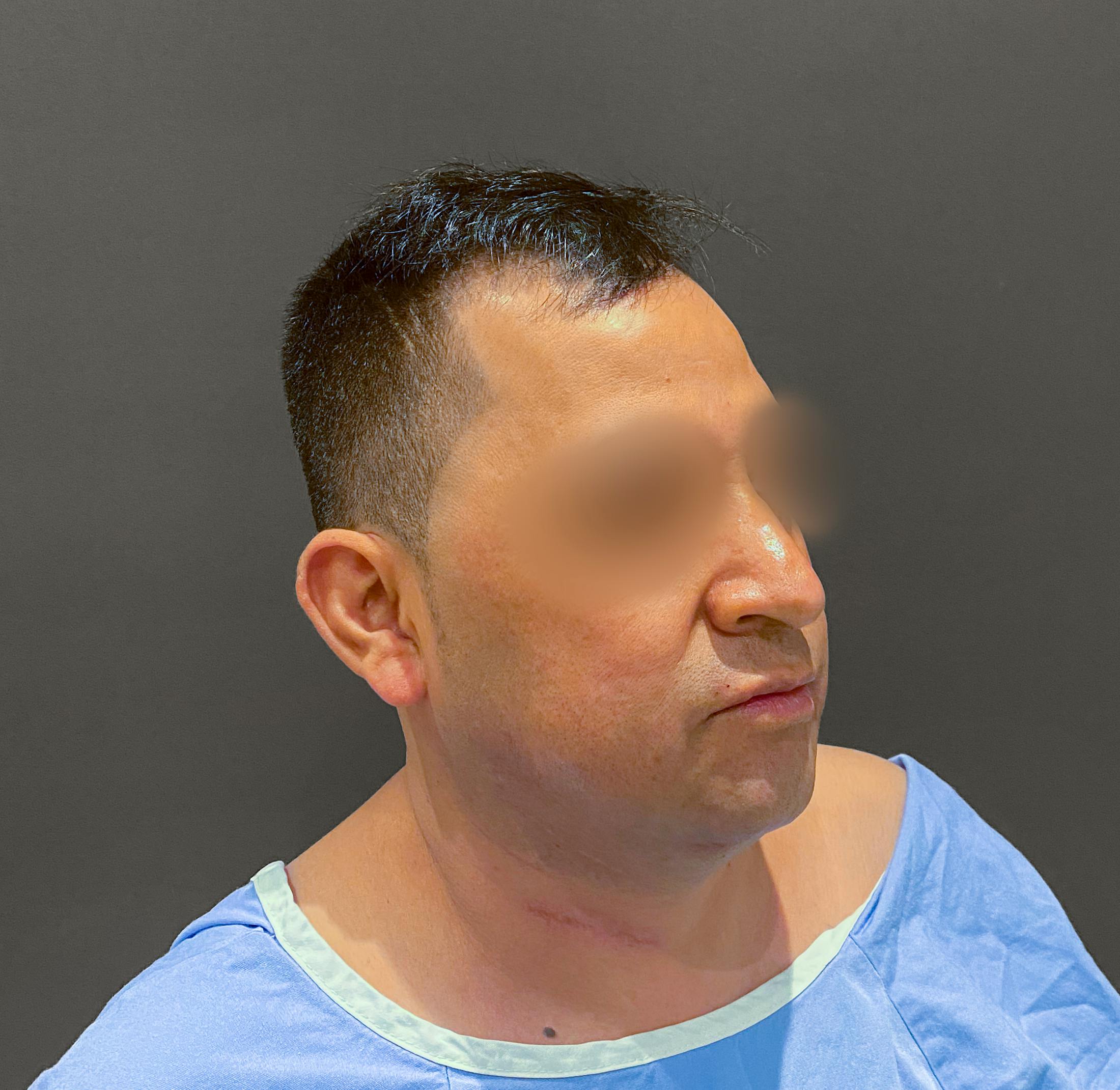 Revision Rhinoplasty Before & After Gallery - Patient 173906475 - Image 7