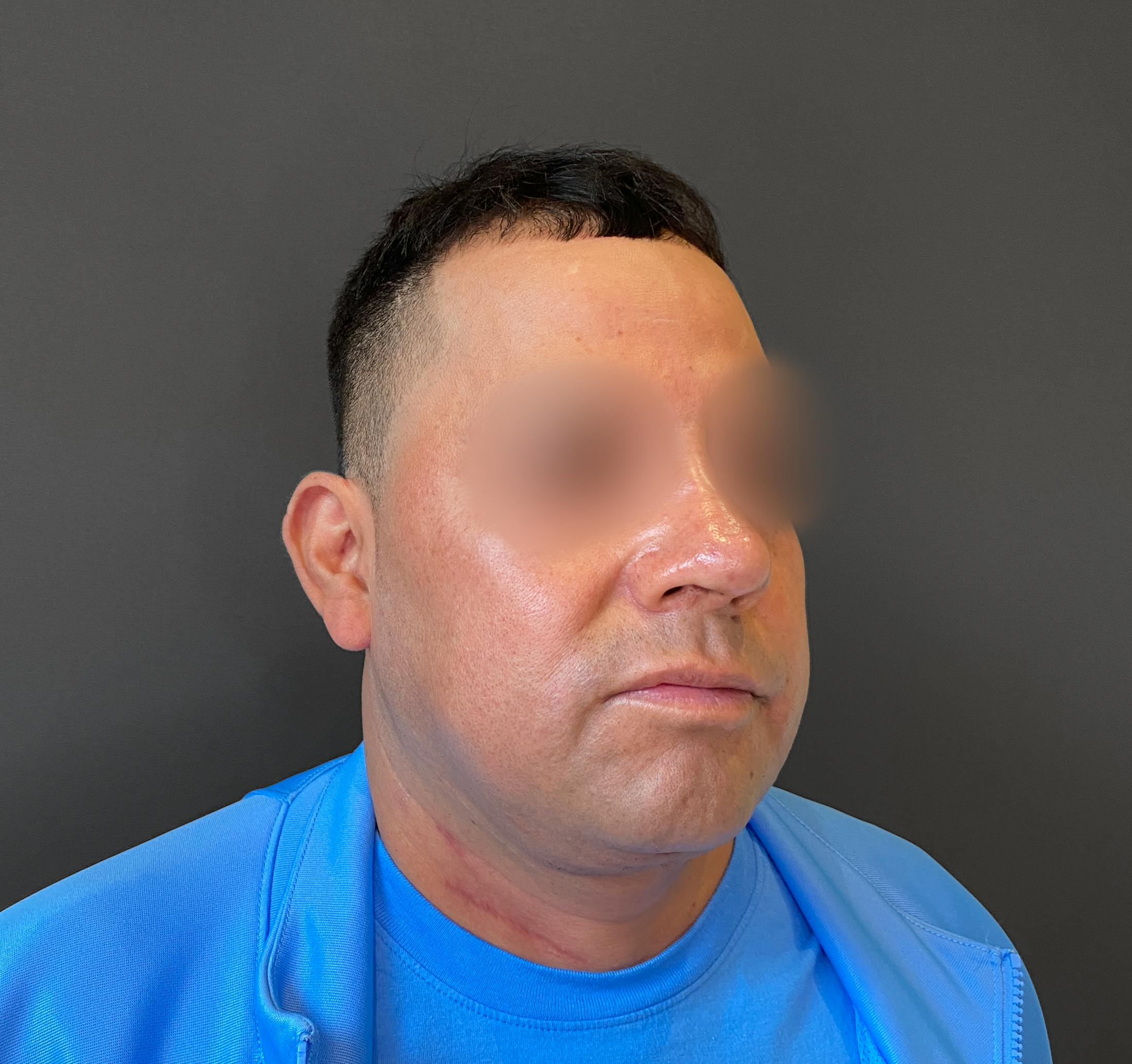 Revision Rhinoplasty Before & After Gallery - Patient 173906475 - Image 8