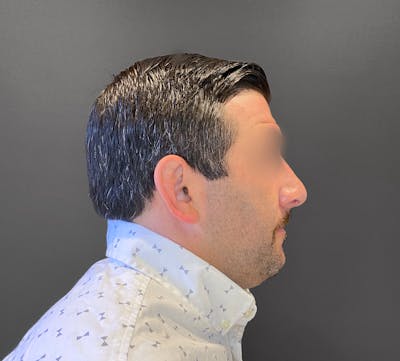 Revision Rhinoplasty Before & After Gallery - Patient 173906476 - Image 2
