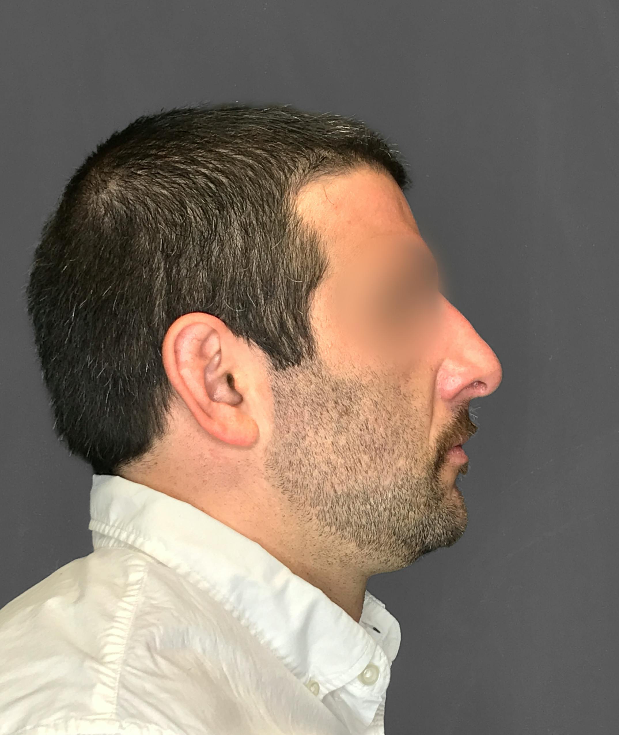 Revision Rhinoplasty Before & After Gallery - Patient 173906476 - Image 1