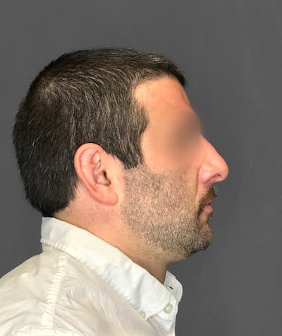 Revision Rhinoplasty Before & After Gallery - Patient 173906476 - Image 1