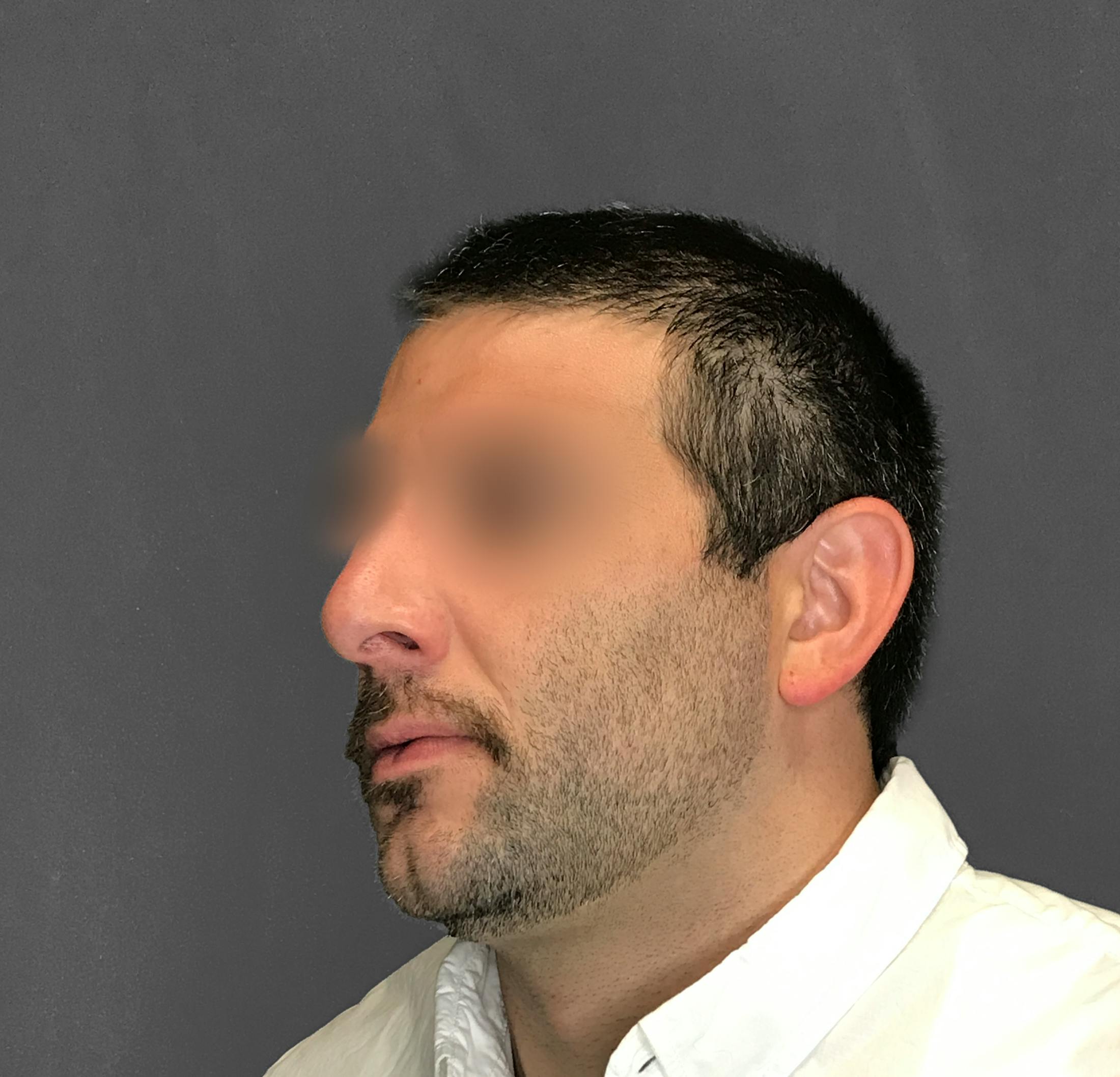 Revision Rhinoplasty Before & After Gallery - Patient 173906476 - Image 5