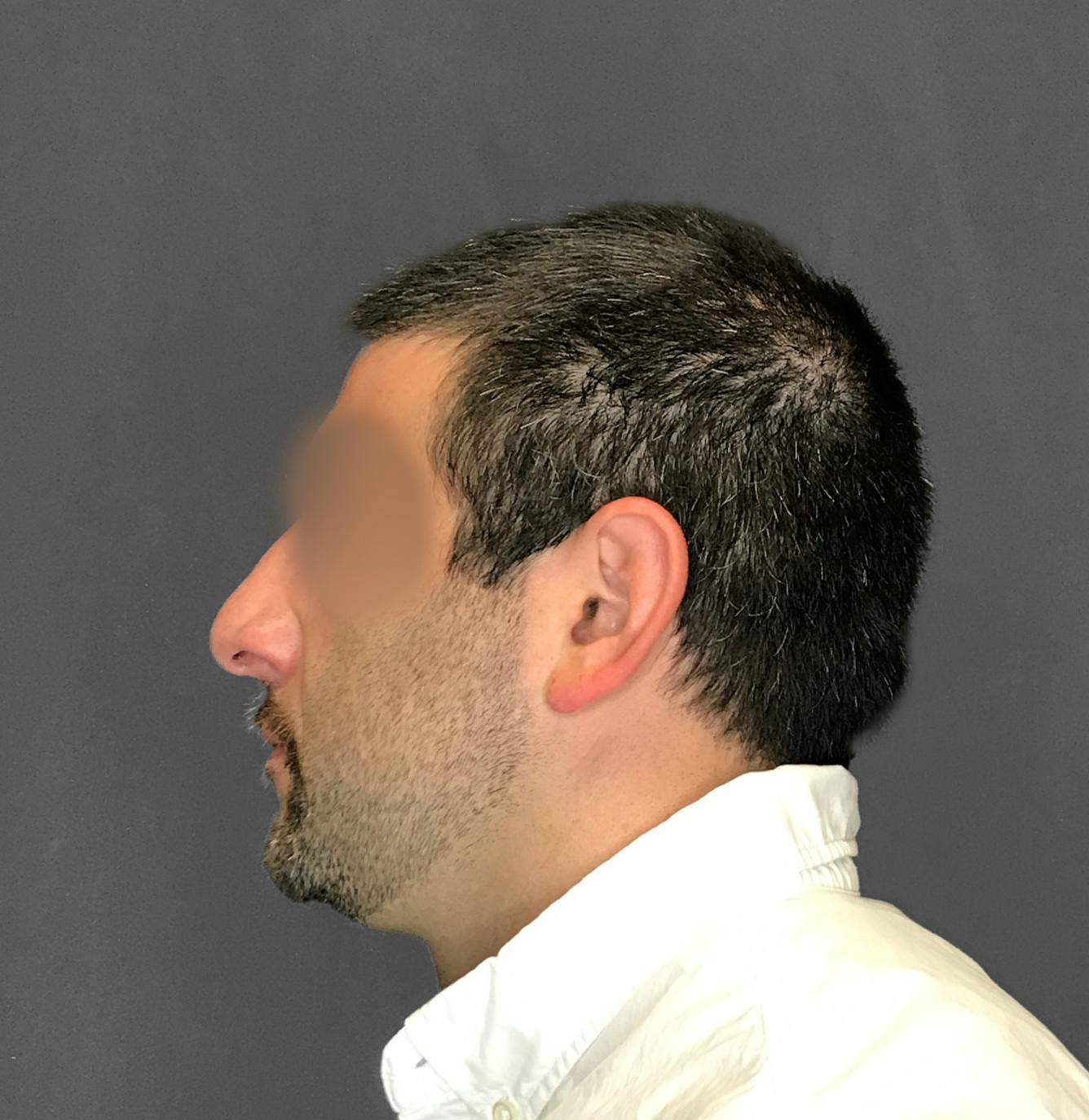 Revision Rhinoplasty Before & After Gallery - Patient 173906476 - Image 7