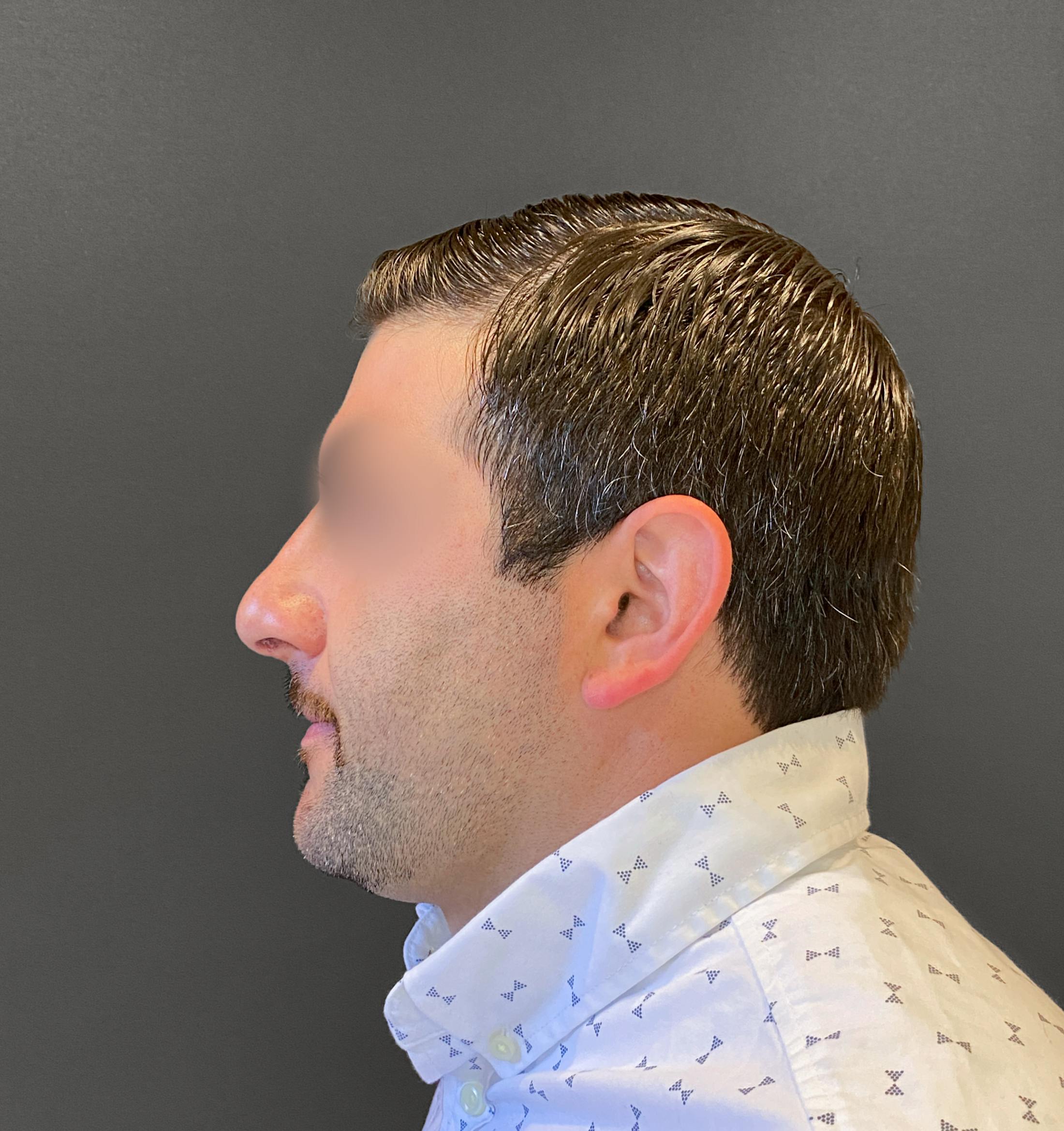 Revision Rhinoplasty Before & After Gallery - Patient 173906476 - Image 8