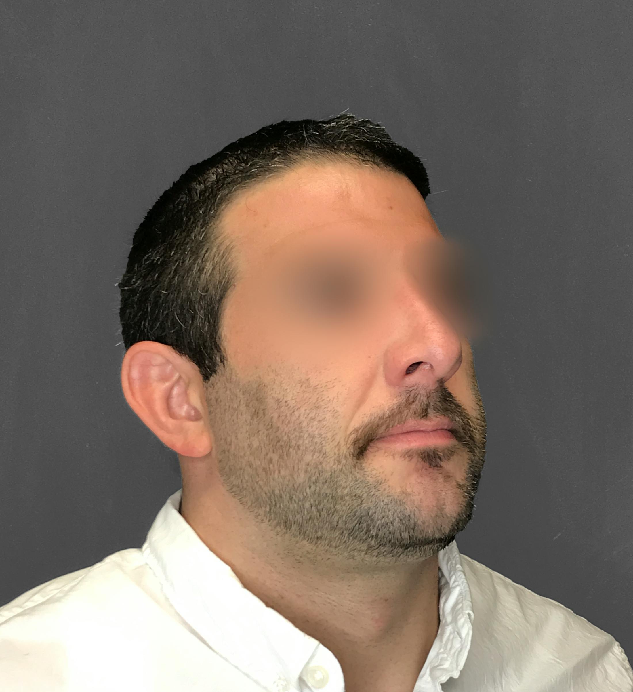 Revision Rhinoplasty Before & After Gallery - Patient 173906476 - Image 9