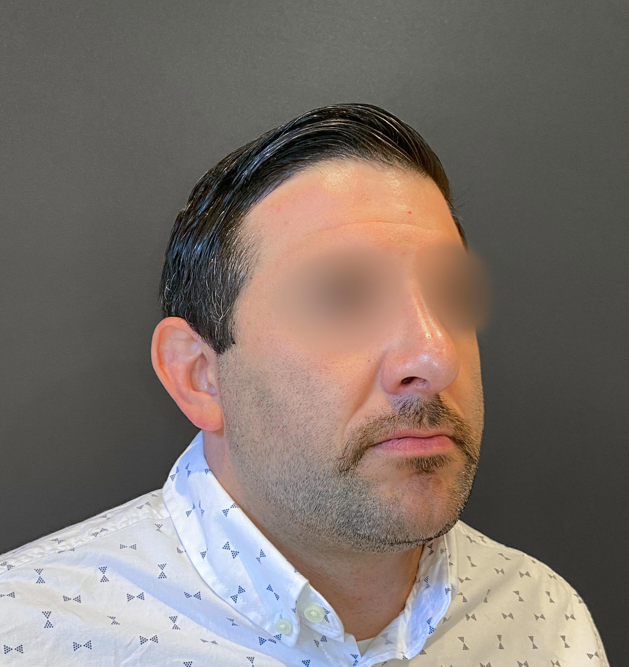 Revision Rhinoplasty Before & After Gallery - Patient 173906476 - Image 10