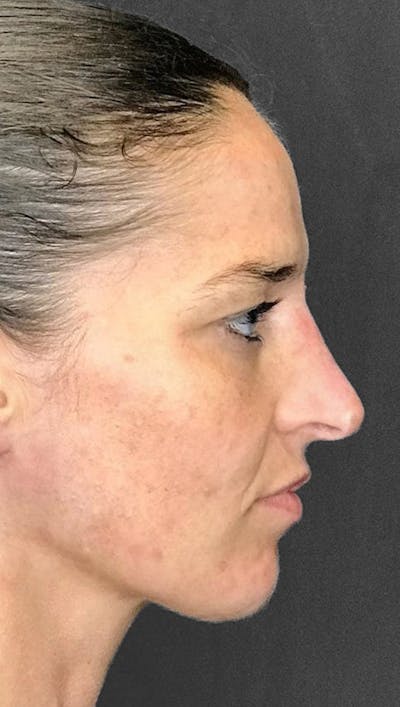 Non-Surgical Rhinoplasty Before & After Gallery - Patient 151452163 - Image 1
